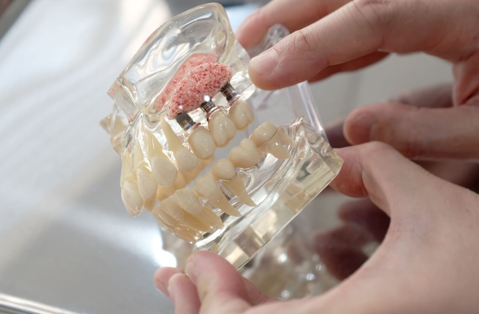 A dental implant and bone graft is shown in the upper jaw of a model set of teeth.